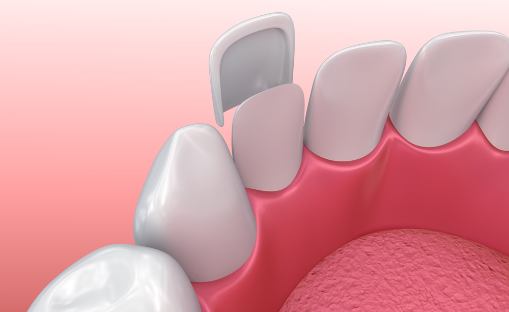 Enhance Your Smile & Confidence with veneers